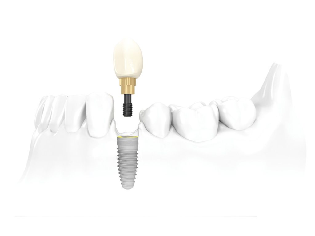 dental implants san antonio