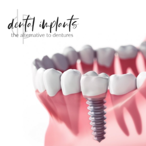 dental implants in San Antonio