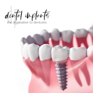 dental implants San Antonio