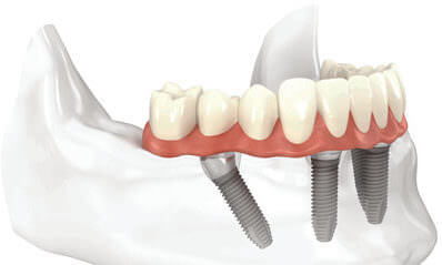 all-on-four dental implants San Antonio