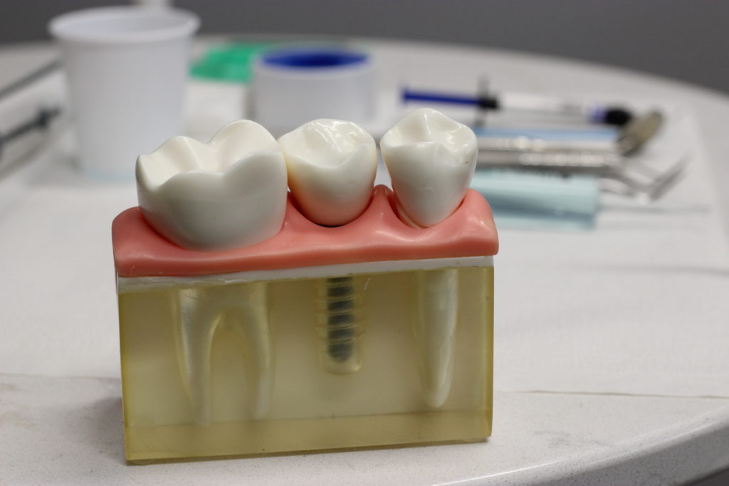 Dental implant model at Alamo Heights Implant Center, San Antonio, TX - Dr. Christopher Walker