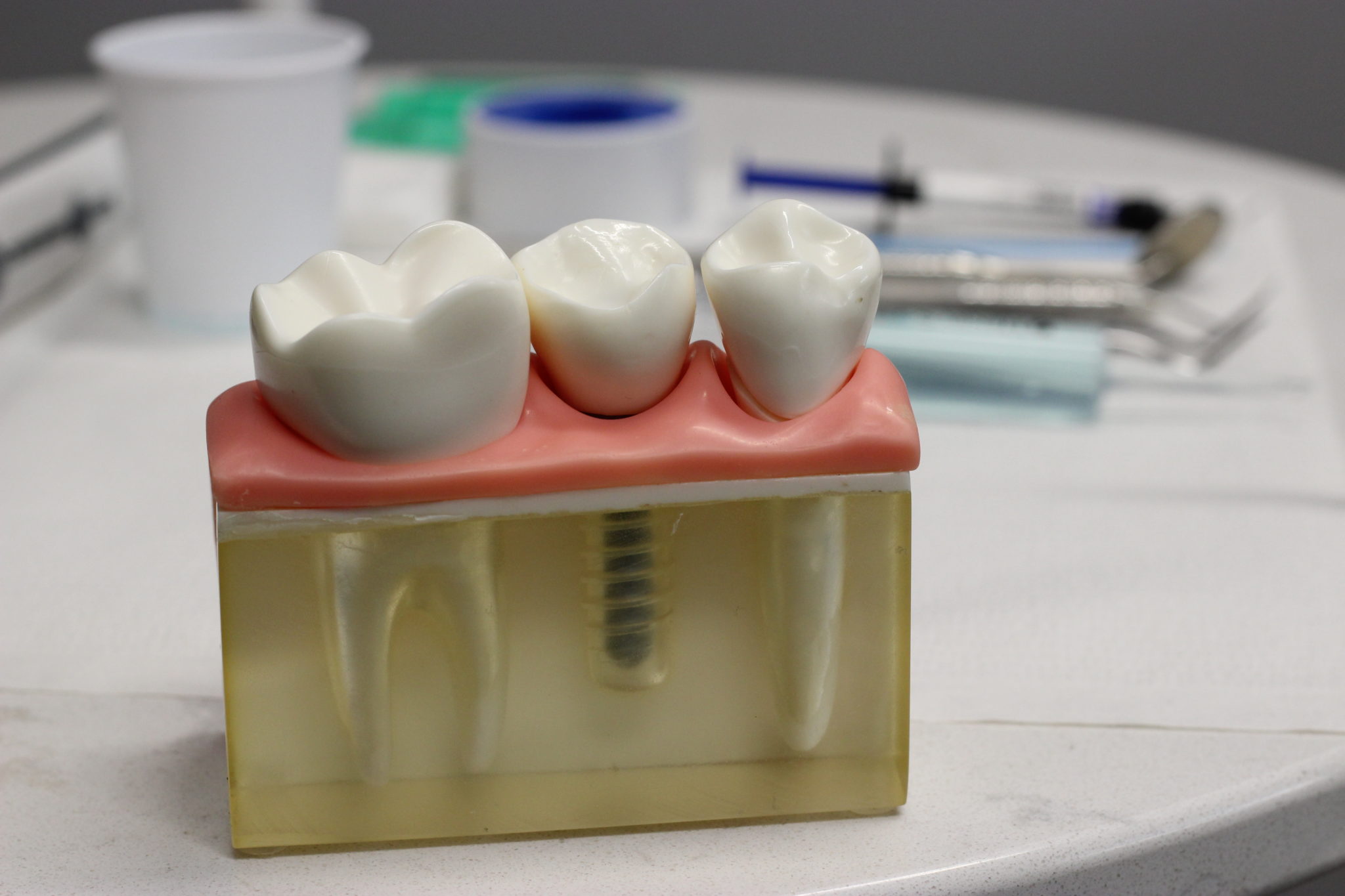 Swollen Gums, Overgrown Gingiva During Orthodontic Treatment: Causes 