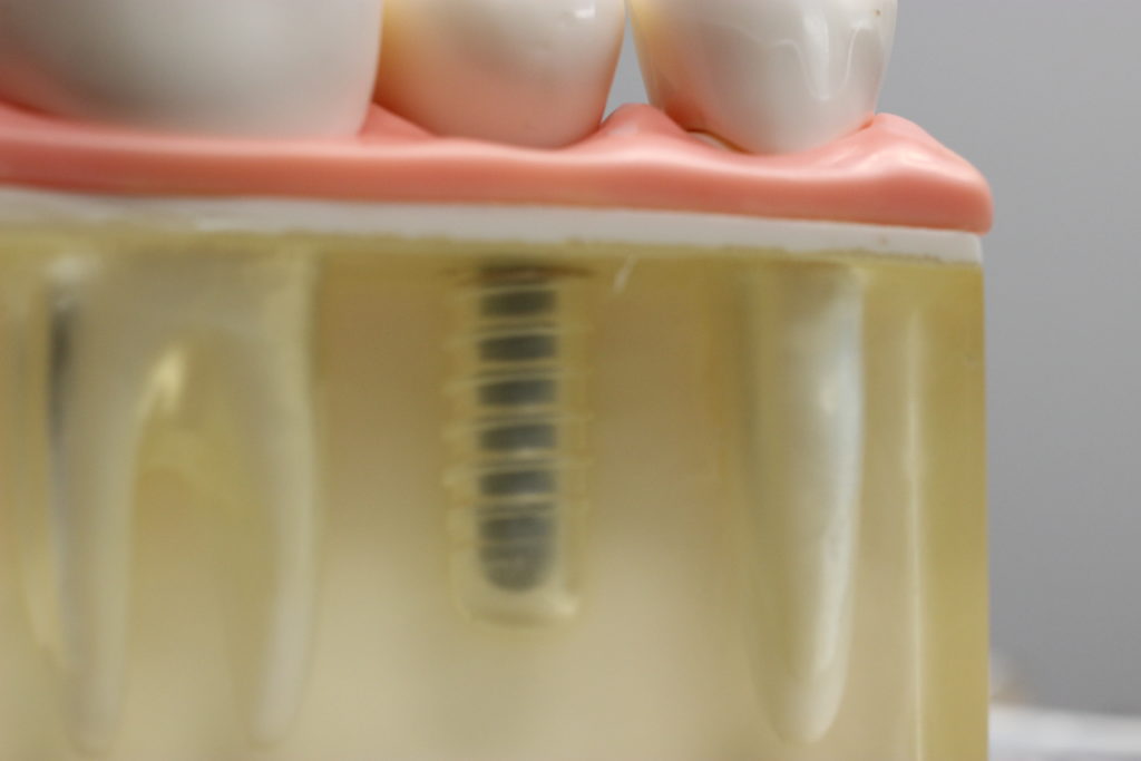 Dental implant model at Alamo Heights Implant Center, San Antonio, TX - Dr. Christopher Walker