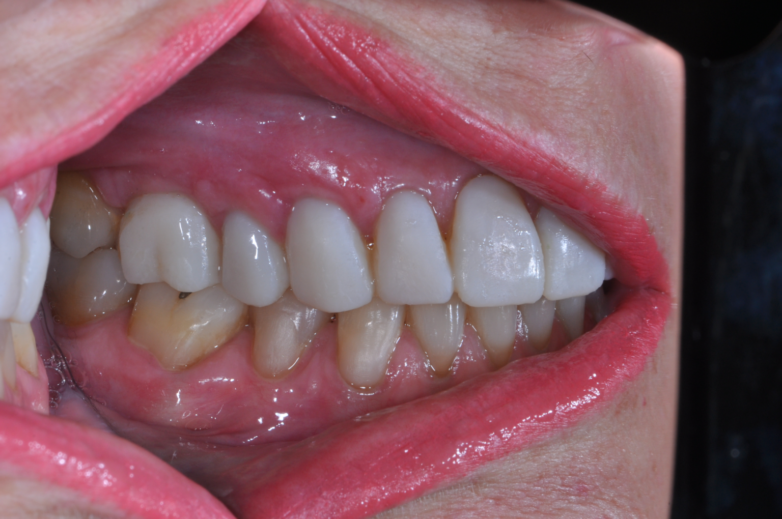 Exposed tooth roots The “root” of tooth sensitivity in aging Alamo