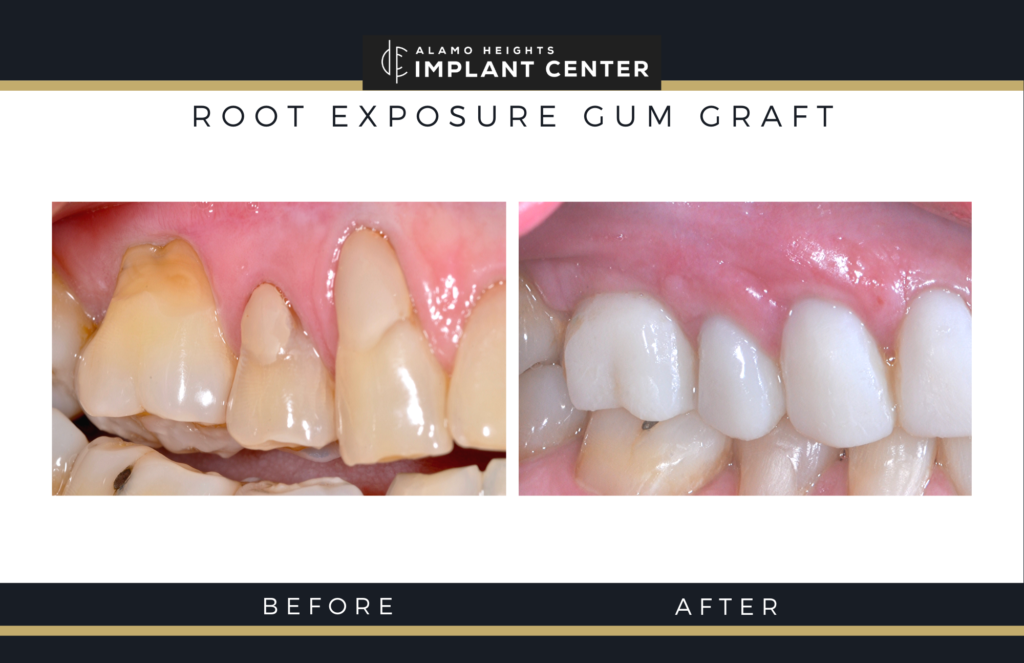 tooth root exposure before and after with gum grafting