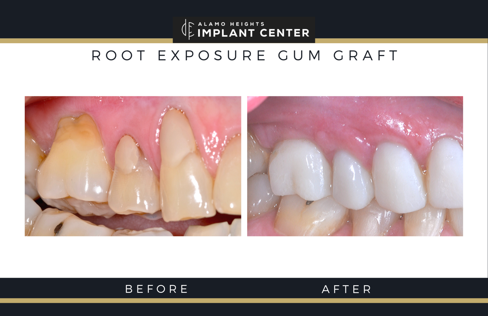 Before and after gum grafting for exposed tooth roots