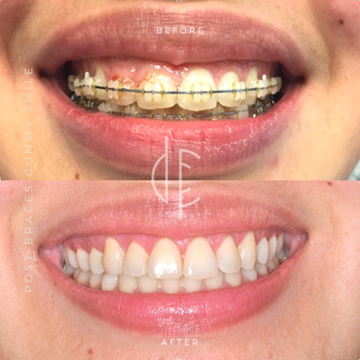 mild gingivitis with braces