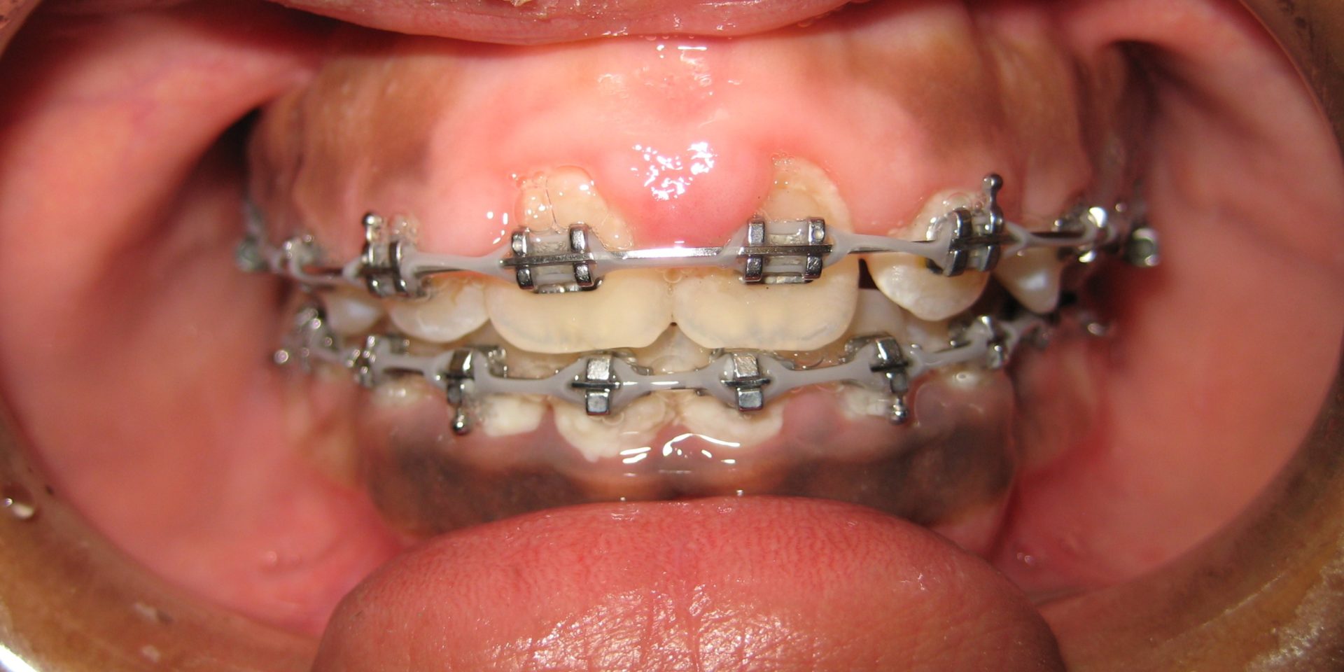 Swollen Gums, Overgrown gingiva during Orthodontic Treatment